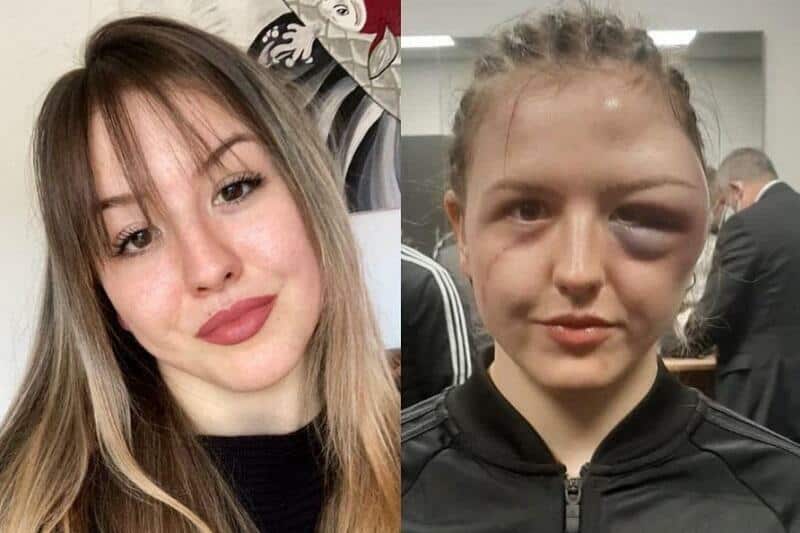 Cheyenne Hanson recovers well from gruesome 'Elephant Woman' injuries