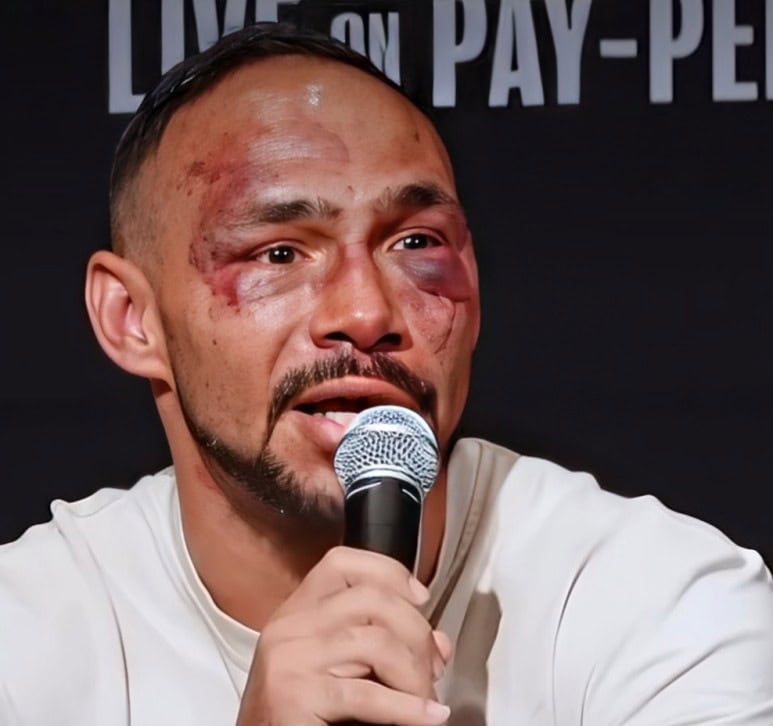 Keith Thurman with bruised and swollen face speaking into a microphone at post-fight press conference after sixth-round TKO loss to Sebastian Fundora in Las Vegas